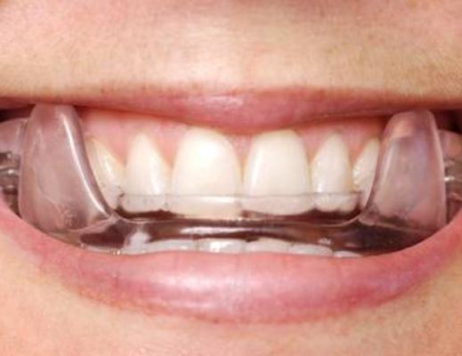 Close up of teeth wearing oral appliance