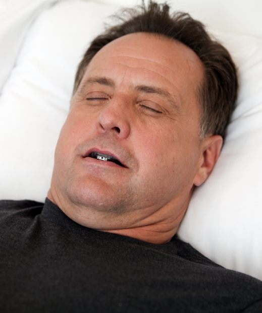 Sleeping man undergoing oral appliance therapy in McKinney